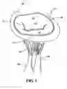 Fig. 02 - Papillary muscle position control devices, systems, and methods