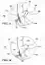 Fig. 09 - Papillary muscle position control devices, systems, and methods