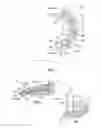 Fig. 02 - Method and implant for replacing damaged meniscal tissue