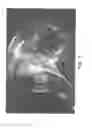 Fig. 03 - Augmented glenoid components and devices for implanting the same