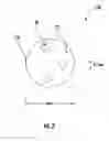 Fig. 03 - Devices and methods for the prevention and treatment of neuromas
