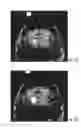 Fig. 22 - MRI-compatible surgical cannulae for transferring a substance to and/or from a patient
