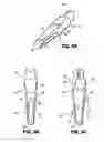 Fig. 06 - Symmetrical tip acute catheter