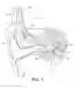 Fig. 02 - Prefitting evaluation of cochlear implant patients