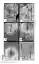 Fig. 05 - Pancreatic insulin-producing beta-cell lines derived from human pluripotent stem cells