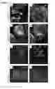 Fig. 08 - Pancreatic insulin-producing beta-cell lines derived from human pluripotent stem cells