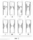 Fig. 03 - METHOD FOR ASSESSING STENOSIS SEVERITY THROUGH STENOSIS MAPPING