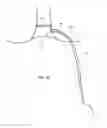 Fig. 08 - FISTULA TREATMENT DEVICES AND METHODS