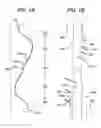 Fig. 02 - Methods and devices for soft palate tissue elevation procedures