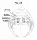 Fig. 04 - Methods and devices for soft palate tissue elevation procedures