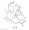 Fig. 02 - SYSTEM AND METHOD FOR TRANSAPICAL ACCESS AND CLOSURE