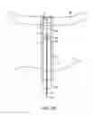 Fig. 12 - SYSTEM AND METHOD FOR TRANSAPICAL ACCESS AND CLOSURE