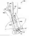 Fig. 01 - Methods and devices for minimally invasive spinal fixation element placement