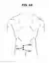 Fig. 05 - Methods and devices for minimally invasive spinal fixation element placement
