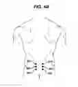 Fig. 06 - Methods and devices for minimally invasive spinal fixation element placement