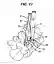 Fig. 15 - Methods and devices for minimally invasive spinal fixation element placement