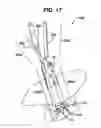 Fig. 20 - Methods and devices for minimally invasive spinal fixation element placement