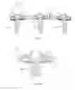 Fig. 08 - Bone anchor locking device