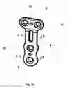 Fig. 02 - Bone plate with attachable wedge