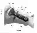 Fig. 12 - Bone plate with attachable wedge