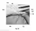 Fig. 16 - Bone plate with attachable wedge