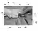 Fig. 17 - Bone plate with attachable wedge