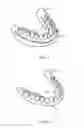 Fig. 02 - Removable system and method for dentures and surgical guides