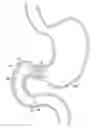 Fig. 01 - Migration-resistant gastrointestinal barrier
