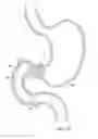 Fig. 06 - Migration-resistant gastrointestinal barrier