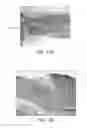 Fig. 12 - METHODS FOR TREATING DISEASES OF THE COLON