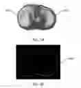 Fig. 22 - Ethnic-specific orthopaedic implants and custom cutting jigs