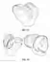 Fig. 32 - Ethnic-specific orthopaedic implants and custom cutting jigs