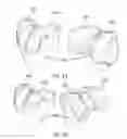 Fig. 37 - Ethnic-specific orthopaedic implants and custom cutting jigs