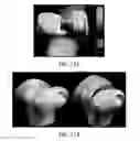 Fig. 63 - Ethnic-specific orthopaedic implants and custom cutting jigs
