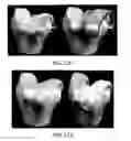 Fig. 67 - Ethnic-specific orthopaedic implants and custom cutting jigs