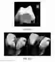 Fig. 69 - Ethnic-specific orthopaedic implants and custom cutting jigs