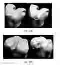 Fig. 71 - Ethnic-specific orthopaedic implants and custom cutting jigs