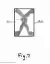 Fig. 08 - Spine surgery method and implant
