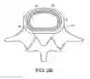 Fig. 04 - In-situ formed intervertebral fusion device and method