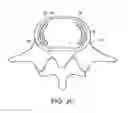 Fig. 05 - In-situ formed intervertebral fusion device and method