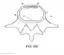 Fig. 06 - In-situ formed intervertebral fusion device and method