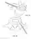Fig. 10 - In-situ formed intervertebral fusion device and method