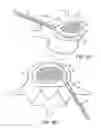 Fig. 11 - In-situ formed intervertebral fusion device and method