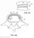 Fig. 15 - In-situ formed intervertebral fusion device and method