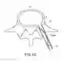 Fig. 16 - In-situ formed intervertebral fusion device and method