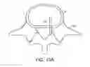 Fig. 21 - In-situ formed intervertebral fusion device and method
