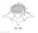 Fig. 24 - In-situ formed intervertebral fusion device and method