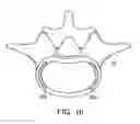 Fig. 28 - In-situ formed intervertebral fusion device and method