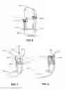 Fig. 06 - MODULAR PROSTHETIC SOCKETS AND METHODS FOR MAKING SAME