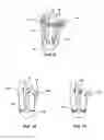 Fig. 07 - MODULAR PROSTHETIC SOCKETS AND METHODS FOR MAKING SAME